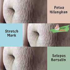 Bagi beberapa orang, nafsu makan akan naik ketika dikecewakan atau sedih. Petua Hilangkan Stretch Mark Selepas Bersalin Shidarahmat