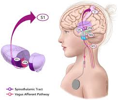 Somatosensory evoked fields predict response to vagus nerve stimulation