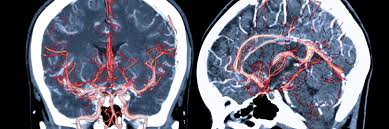Because doctors can observe blood flow in real time, a cerebral angiogram can make it easier to identify areas of abnormality, such as blockage, narrowing (stenosis) or leakage. Cerebral Angiography St Charles Health