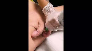 Laser Hair Removal Porn Videos | xHamster