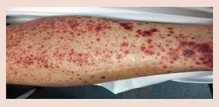 Purpura occurs when small blood vessels join together or leak blood under the skin. Palpable Purpuric Rashes On The Anterolateral Aspect Of The Leg Download Scientific Diagram