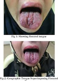 Image result for Fissured tongue