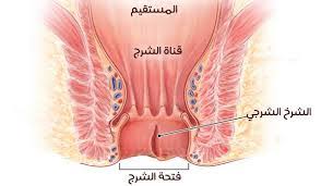 علاج الشرخ في المنزل الحلقة