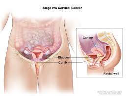 How do i know if i have cervical cancer? Cancerhelp Online Nci Cancer Diagnosis And Treatment