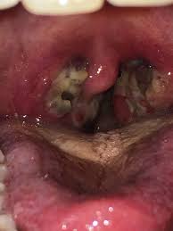 Evidently, chronic throat infection is one of the most common reasons adults have their tonsils removed. Need Tonsils Removed Asap Due To Chronic Tonsillitis Https Www Gofundme Com Tonsil Removal And School Gofundme