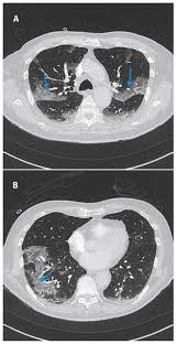 Tdm is simply the transmission of information from several different sources using one common channel or. Prelevements Nasopharynges Initialement Negatifs Chez Un Homme De 76 Ans Infecte Par Le Sras Cov 2 Cmaj