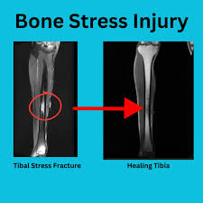 Image result for Tibia Stress Fracture