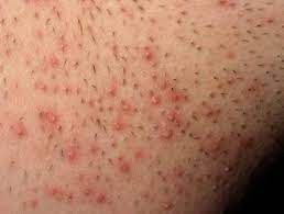 Pseudofolliculitis Barbae (Razor Bumps): Images And Management - Dermnet