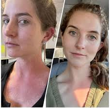 Hi all! I bought Mielle Rosemary Oil from The Skinfit. I applied it