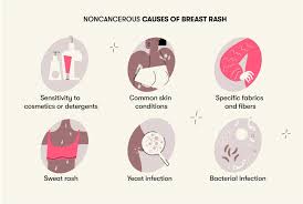 Image result for Inflammatory breast cancer