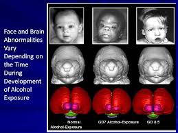 Research Projects Phase Iii Projects Cifasd Collaborative Initiative On Fetal Alcohol Spectrum Disorders