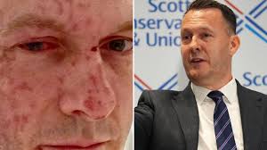 Who is new Scottish Tory leader Russell Findlay and what happened with his  acid attack?