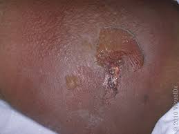 Image result for wolf spider bite skin