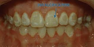 After all the time, effort, and expense put into braces, these stains, caused by plaque that accumulated on the teeth around the brace attachment points, can seem doubly frustrating. Teeth After Braces Stains Shefalitayal