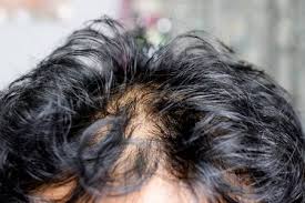 Regeneration, degeneration, and a rest cycle. Does An Oily Scalp Cause Hair Loss Touchups Salon