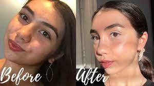 Try our symptom checker got any. Fungal Acne Clearing Skincare Routine How To Clear Fungal Acne