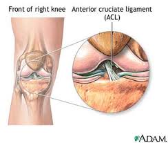 Acl stands for anterior cruciate ligament and it is one of four ligament in the knee. Acl Tear Brisbane Knee And Shoulder Clinic Dr Kelly Macgroartybrisbane Knee And Shoulder Clinic