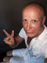 Catwoman's fiancé Lloyd Klein unveils his new face after rejuvenation  procedure