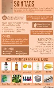 10 Surprising Home Remedies For Skin Tags Plus Ways To Reduce Your Risk Of Getting Them Home Remedies For Skin Remedies Natural Home Remedies