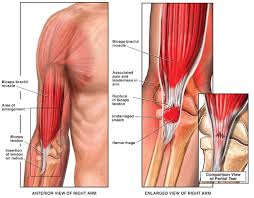 Distal Bicep Tendon Insertion Biceps Bicep Tendonitis Golfers Elbow