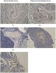 Transitional cell carcinoma (tcc) is the most common cancerous condition affecting the urinary tract of dogs. Frontiers A Specific Blood Signature Reveals Higher Levels Of S100a12 A Potential Bladder Cancer Diagnostic Biomarker Along With Urinary Engrailed 2 Protein Detection Oncology
