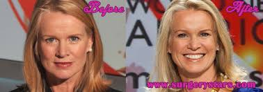 Katty Kay Plastic Surgery Before and After Photos