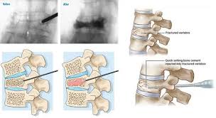Image result for Vertebral Compression Fracture