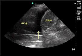 Image result for Hemothorax