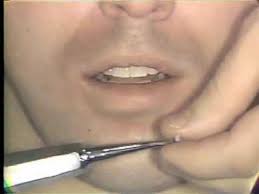 62 cementation jobs available on indeed.com. Orthodontic Banding Of First Permanent Molar Youtube