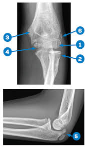 The much smaller lateral epicondyle of the humerus is found on the lateral side of the distal humerus. How To Avoid Missing A Pediatric Elbow Fracture Acep Now