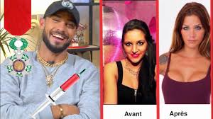 L'acuité visuelle (av) moyenne corrigée finale était de 5,75/10e pour les formes bilatérales, et de 4,16/10e. Julia Paredes Son Chirurgien Merite La Legion D Honneur Youtube