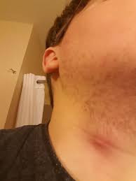 Ingrown hairs, or hairs that have become embedded into the skin, occur commonly as a result of shaving and other hair removal methods. Neck Lump Album On Imgur