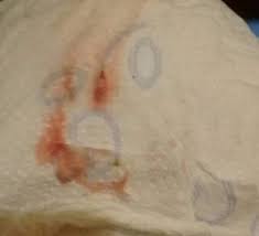 Sangrado De Implantacion Primeros Sintomas Babycenter