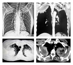 Pancoast tumors form at the very top of either lung. Pancoast S Syndrome Due To Fungal Abscess In The Apex Of Lung In An Immunocompetent Individual A Case Report And Review Of The Literature