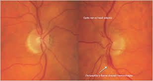 He or she will dilate (widen) your pupils with eye drops and then check for swelling of the optic nerve and blood vessels in the back of your eye. Optometric Management Clinical Posterior