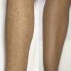 Laser Hair Removal Ingrown Hair Scars