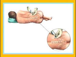 Como Se Usa La Inyeccion Epidural Youtube