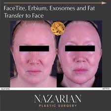 Experience the future of facial rejuvenation with Dr. Sheila Nazarian's  favorite treatment combination: FaceTite, Fat Transfer, Erbium Laser, and  Exosomes. Start with FaceTite, a groundbreaking procedure that tightens  skin and boosts collagen