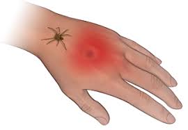 If you develop an allergic reaction to a spider bite, with symptoms such as tightness in the chest, breathing a bite from a poisonous spider like the black widow or brown recluse is extremely dangerous and can cause a severe reaction. When Spiders Bite