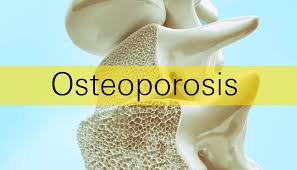 BODY DYNAMICS--Osteoporosis: exercise to prevent exercise to thrive.