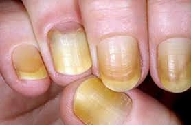 لون الأظافر يحدد نوع المرض اخبار