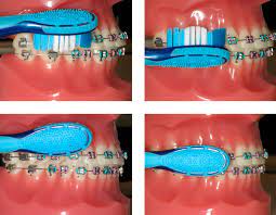 But, have you ever asked yourself whether you've been brushing them correctly you should brush every tooth with vertical motions, and it's not recommended to brush across them. Brushing With Braces Orthodontic Treatment In Wollongong Smile Team Orthodontics