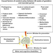 Pathophysiology Of Cerebral Palsy Sciencedirect