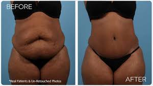 For the first 6 weeks, patients may not participate in any. Charlotte Age 46 Female Liposuction Tummy Tuck Case 2419 Before After Plastic Surgery Charlotte Plastic Cosmetic Surgeon Aesthetic Surgery Of Charlotte