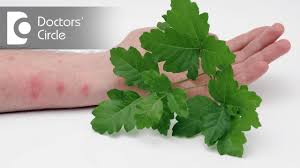 In a nutshell, the best solution to block the chickenpox is immunizing a vaccine. How To Get Rid Of Chickenpox Scars Dr Rasya Dixit Youtube