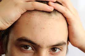 Acne En La Adolescencia Planeta Mama