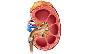 The Craziest Way To Pass A Kidney Stone Plus 7 More Things You Didn T Know About Kidney Stones Kidney Stones Renal Stones Chronic Kidney Disease