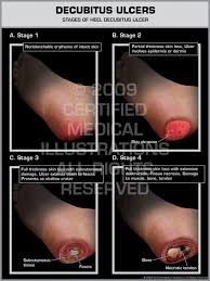 Decubitus Ulcers Stages Of Heel Decubitus Ulcer Print Quality Instant Download Wound Care Nursing Pressure Ulcer Neonatal Nurse