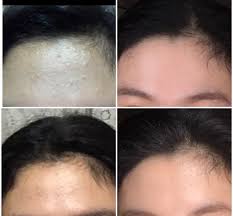 It occurs when oil secreted by sebaceous glands clogs the hair follicle. B A Nizoral Shampoo My True Hero Skincareaddiction