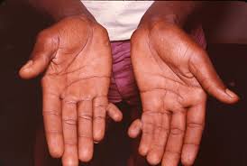 Au cinema, le specialiste des effets sonores. Polydactylie Des Capacites Motrices Augmentees Rhumatologie Orthopedie Jm Update Specialiste Lejournaldumedecin Com